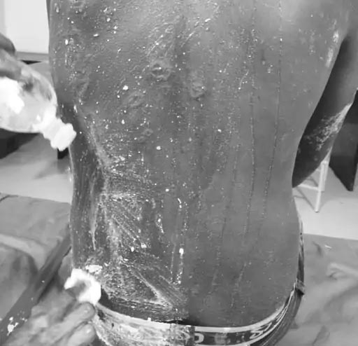 राजगढ़: कार-बाइक की टक्कर के बाद हुए विवाद में 6 लोगों पर एसिड अटैक, 3 1757674448 Untitled 4 copy